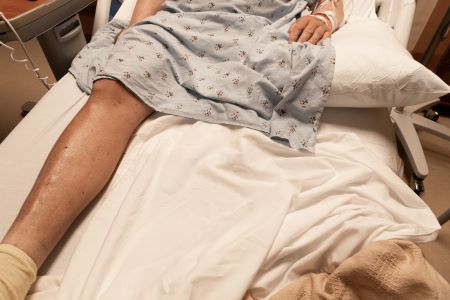 Single leg of an amputee man in a hospital bed