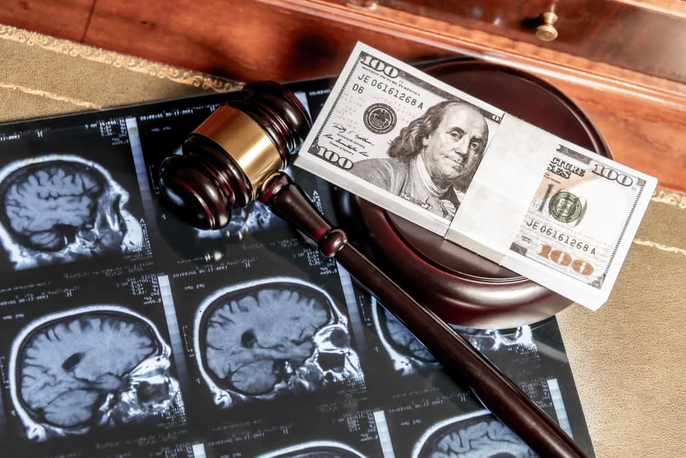 brain injury compensation